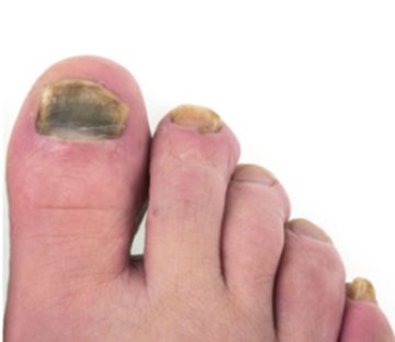 Fungo Killer - Skuteczne Rozwiązanie na Grzybice - overview